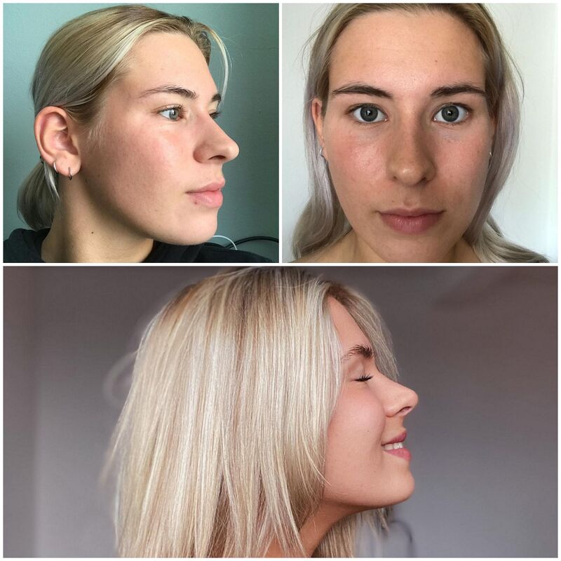 Beste keuze ooit geweest! Blij met mijn Neus!