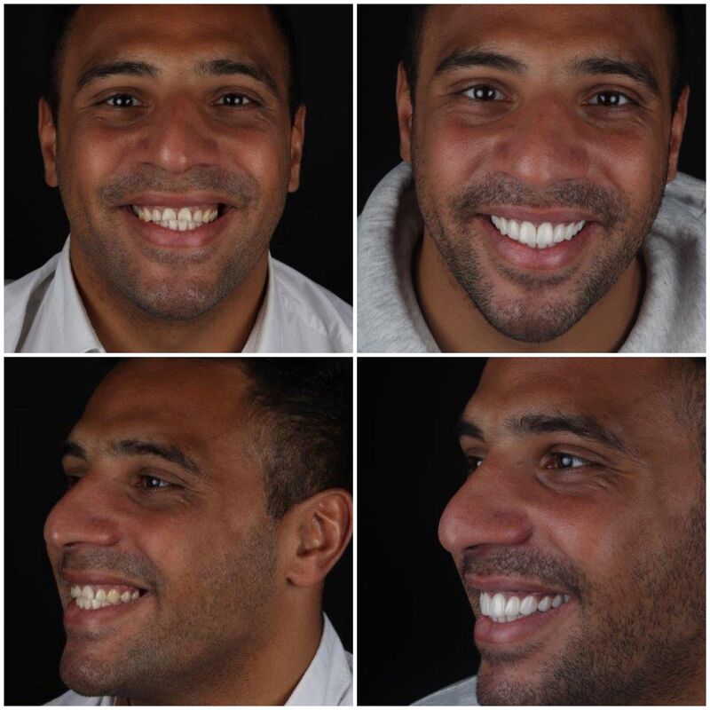 Kronen en facings Turkije samen met tante en moeder.