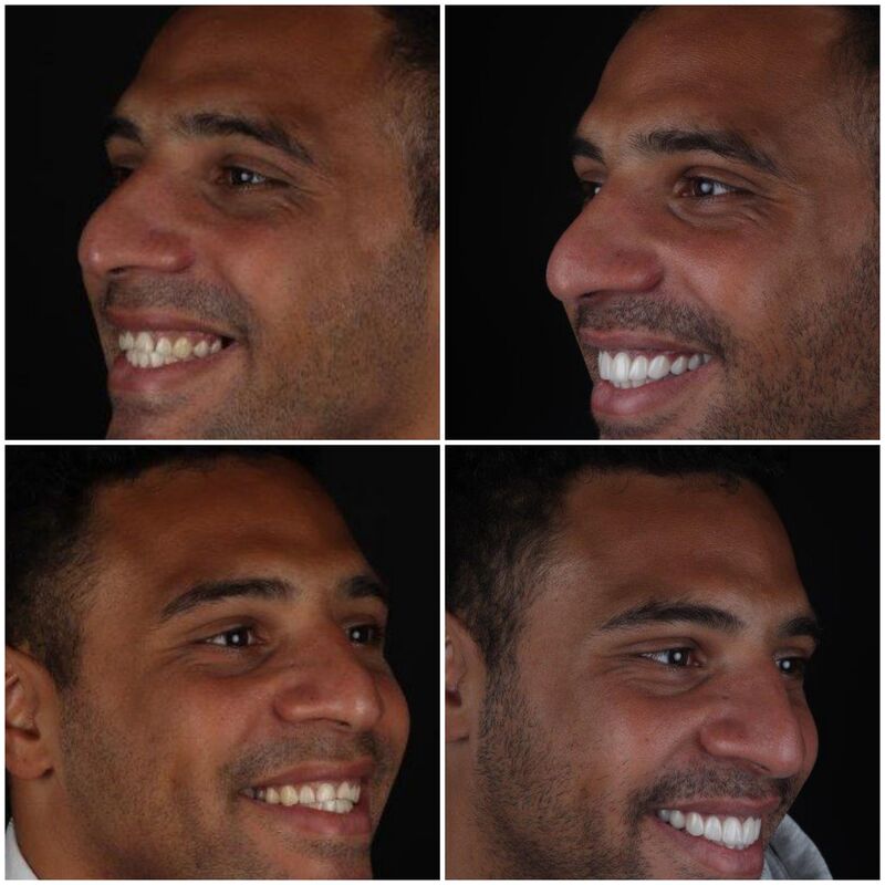 Kronen en facings Turkije samen met tante en moeder.