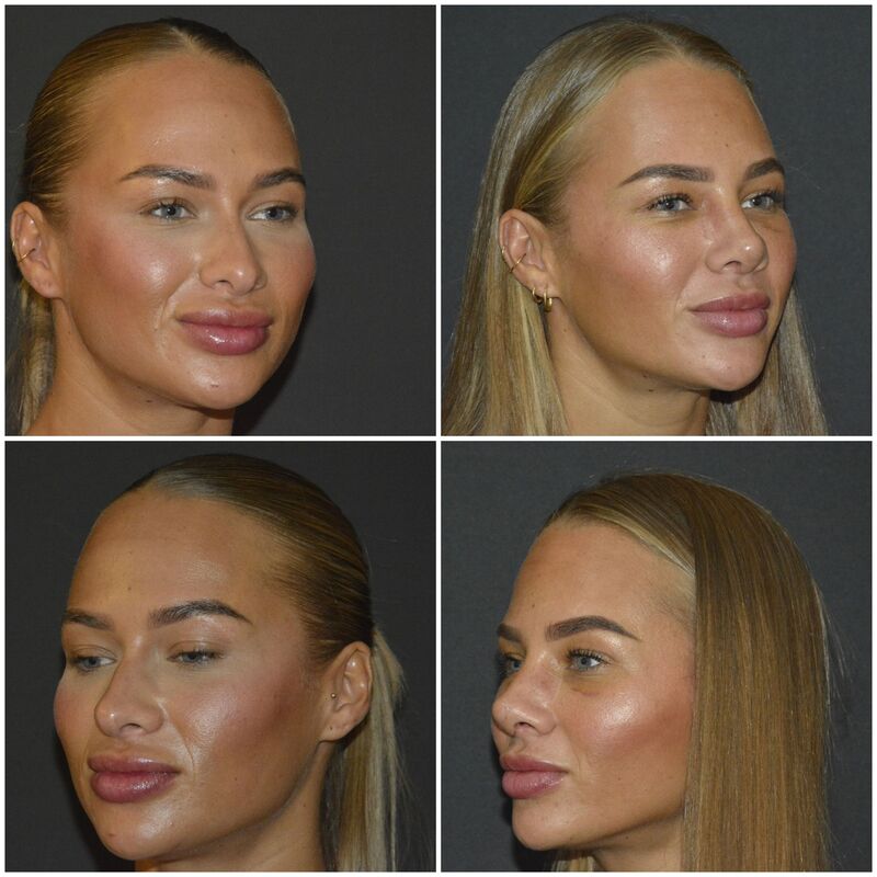 @Annebelvisscher influencer Neuscorrectie Turkije