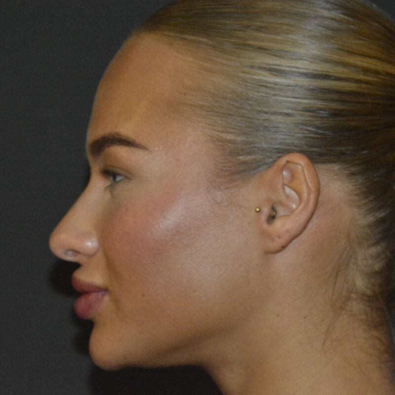 @Annebelvisscher influencer Neuscorrectie Turkije