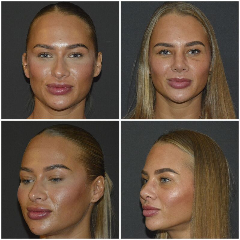 @Annebelvisscher influencer Neuscorrectie Turkije