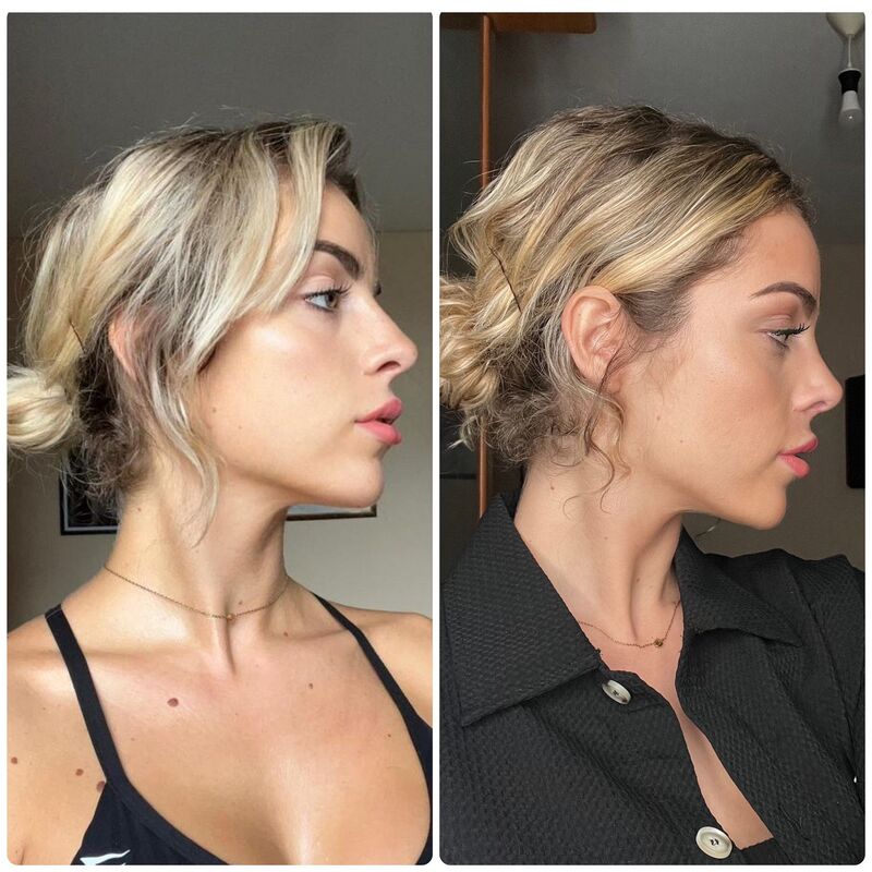 Influencer @eilishflesch neuscorrectie beste keus ooit!