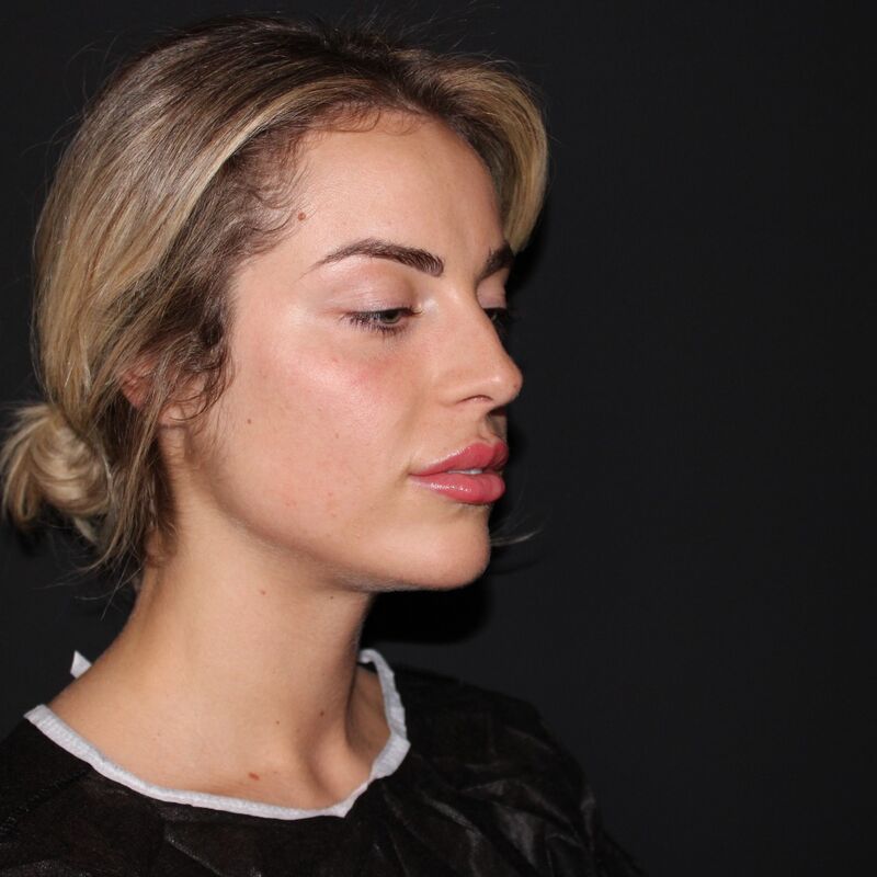 Influencer @eilishflesch neuscorrectie beste keus ooit!