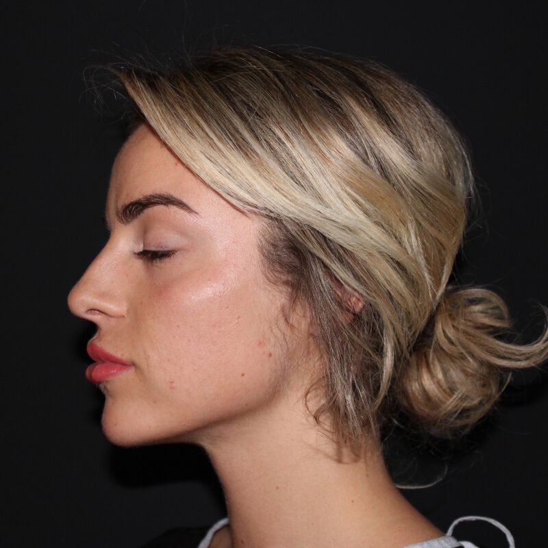 Influencer @eilishflesch neuscorrectie beste keus ooit!