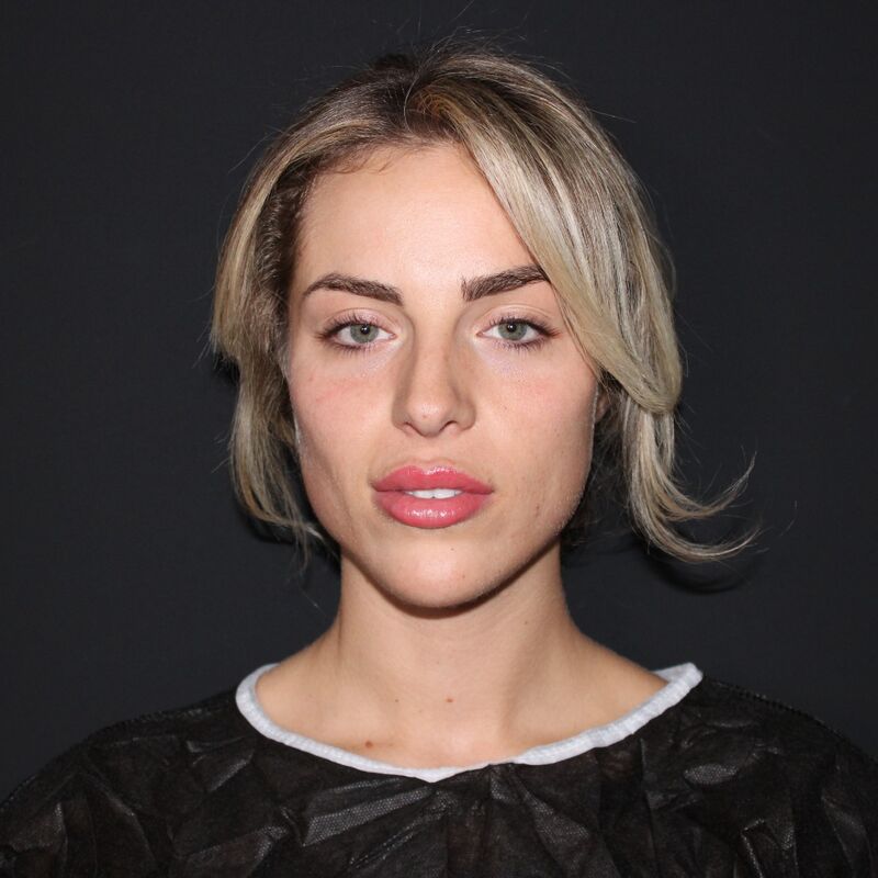 Influencer @eilishflesch neuscorrectie beste keus ooit!