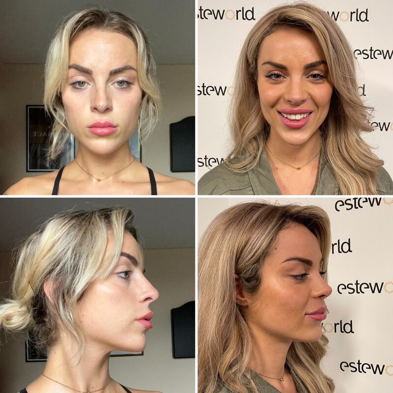 Influencer @eilishflesch neuscorrectie beste keus ooit!