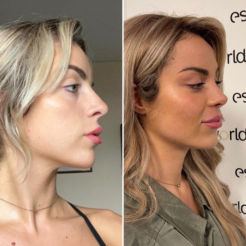 Influencer @eilishflesch neuscorrectie beste keus ooit!