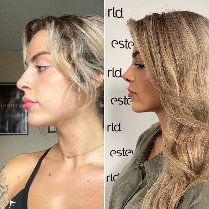 Influencer @eilishflesch neuscorrectie beste keus ooit!