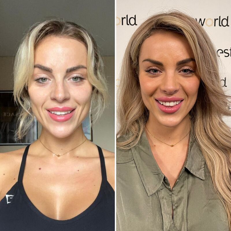 Influencer @eilishflesch neuscorrectie beste keus ooit!