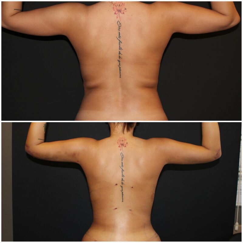 De BBL en liposuctie van Rebecca bij Esteworld