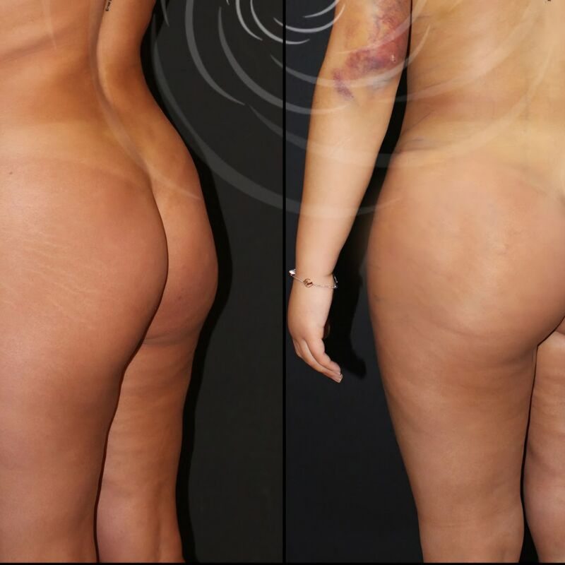 De BBL en liposuctie van Rebecca bij Esteworld