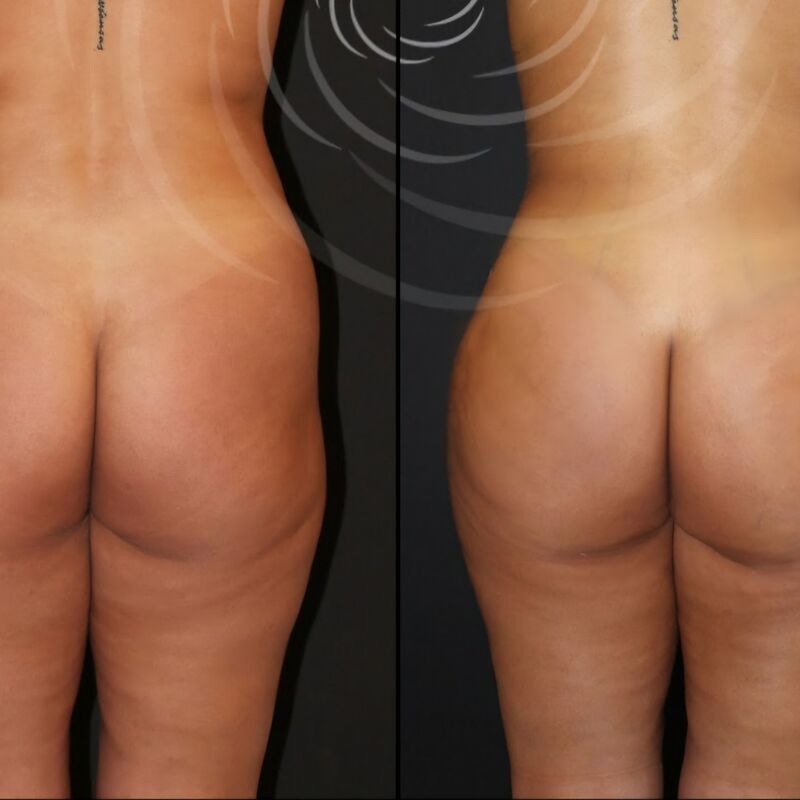 De BBL en liposuctie van Rebecca bij Esteworld