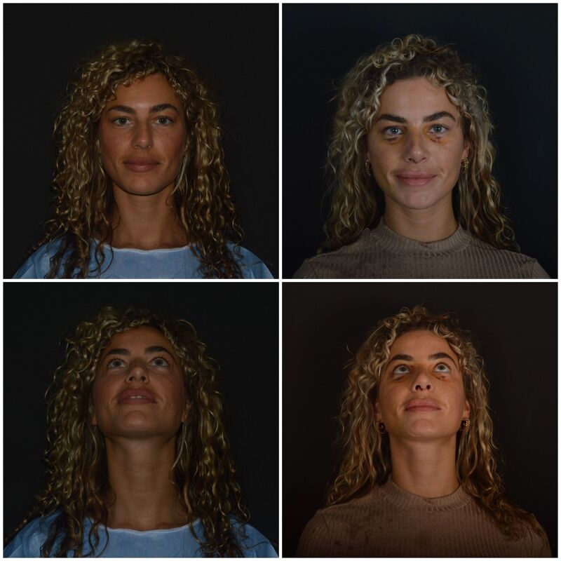 Playmate en Influencer Nena Vlaar haar neuscorrectie