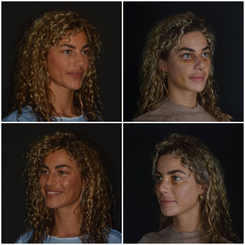 Playmate en Influencer Nena Vlaar haar neuscorrectie