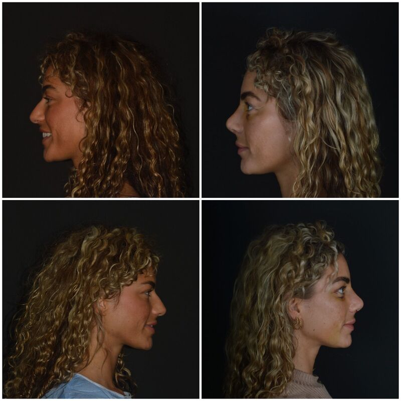 Playmate en Influencer Nena Vlaar haar neuscorrectie