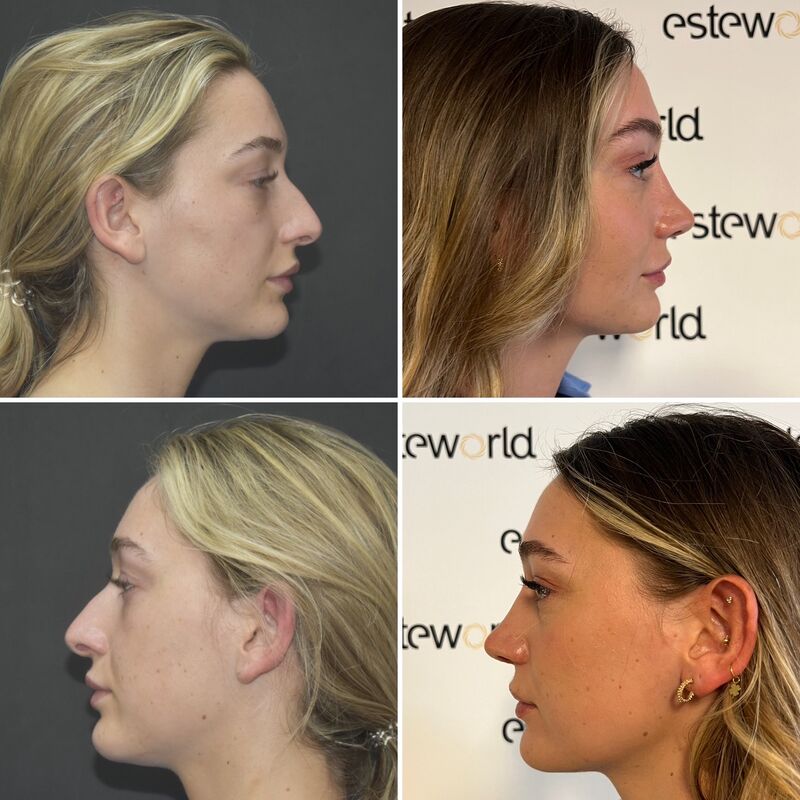 Ik droomde al van een neuscorrectie