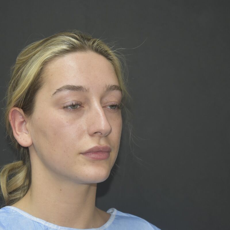 Ik droomde al van een neuscorrectie