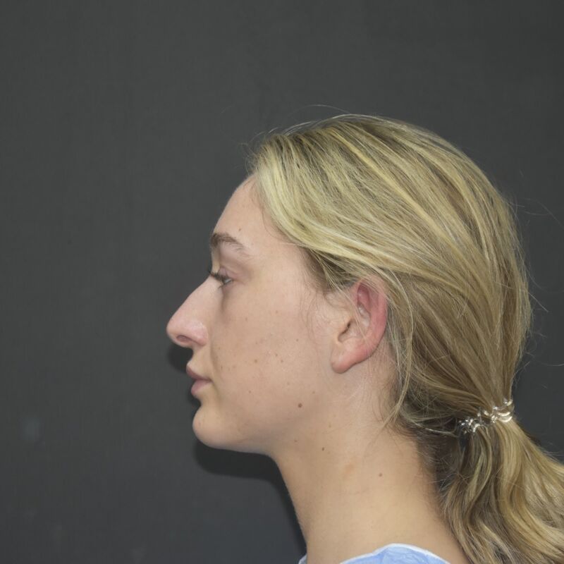 Ik droomde al van een neuscorrectie