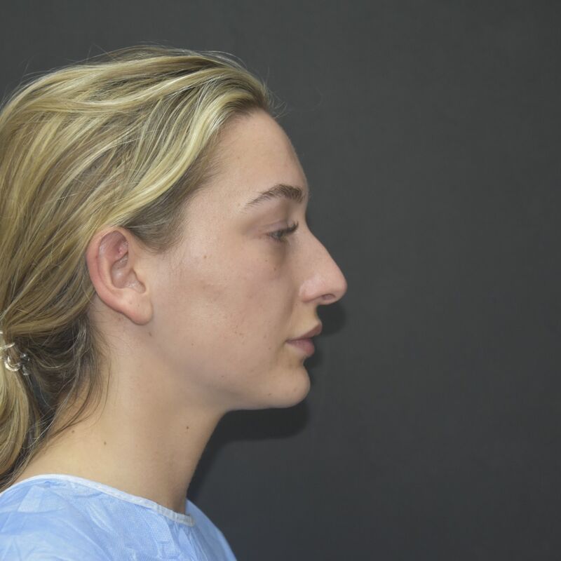 Ik droomde al van een neuscorrectie