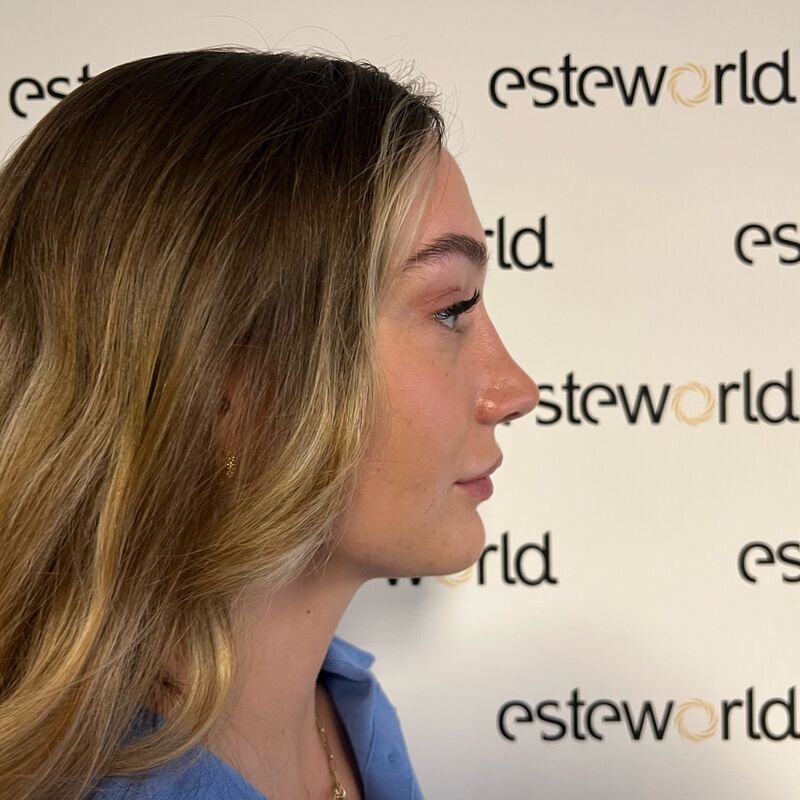 Ik droomde al van een neuscorrectie