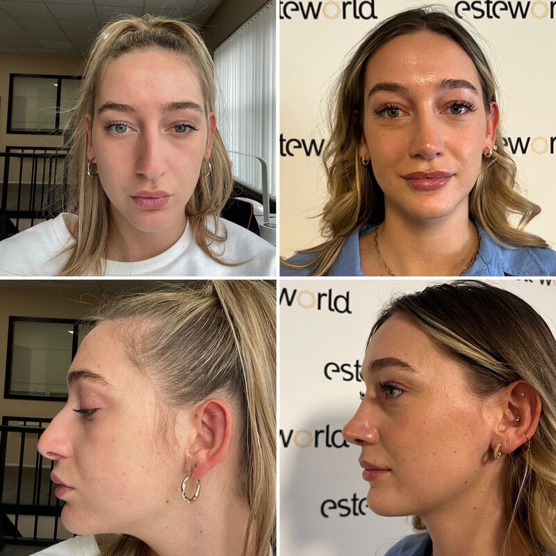 Ik droomde al van een neuscorrectie