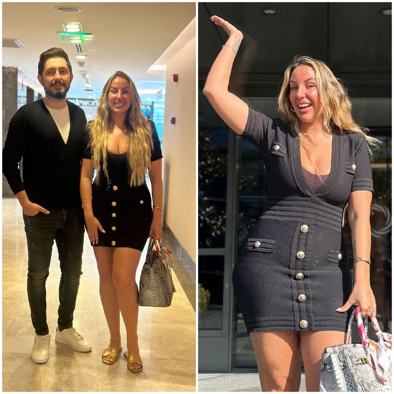 Avram voor Buikwandcorrectie plus Lipo