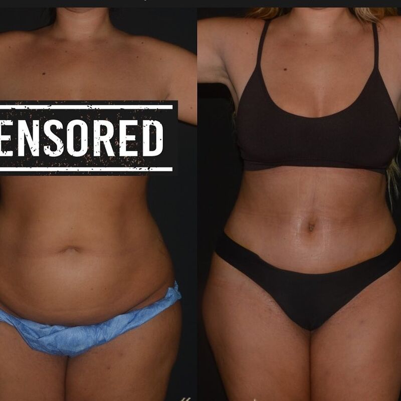 Avram voor Buikwandcorrectie plus Lipo