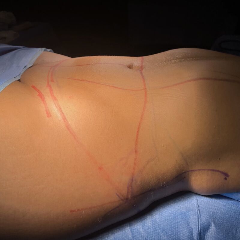 Avram voor Buikwandcorrectie plus Lipo