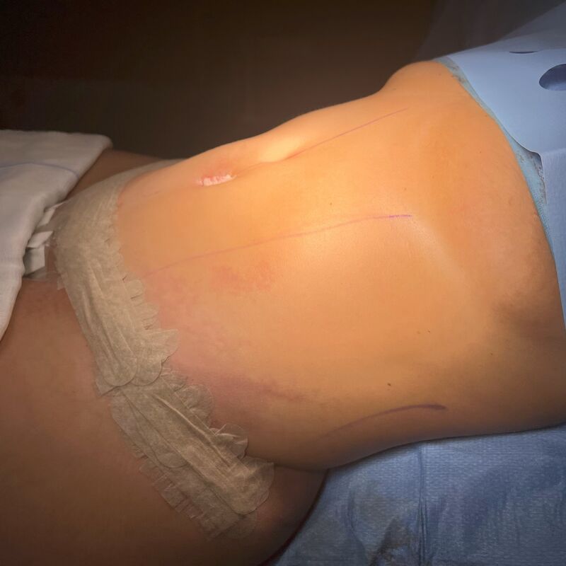 Avram voor Buikwandcorrectie plus Lipo