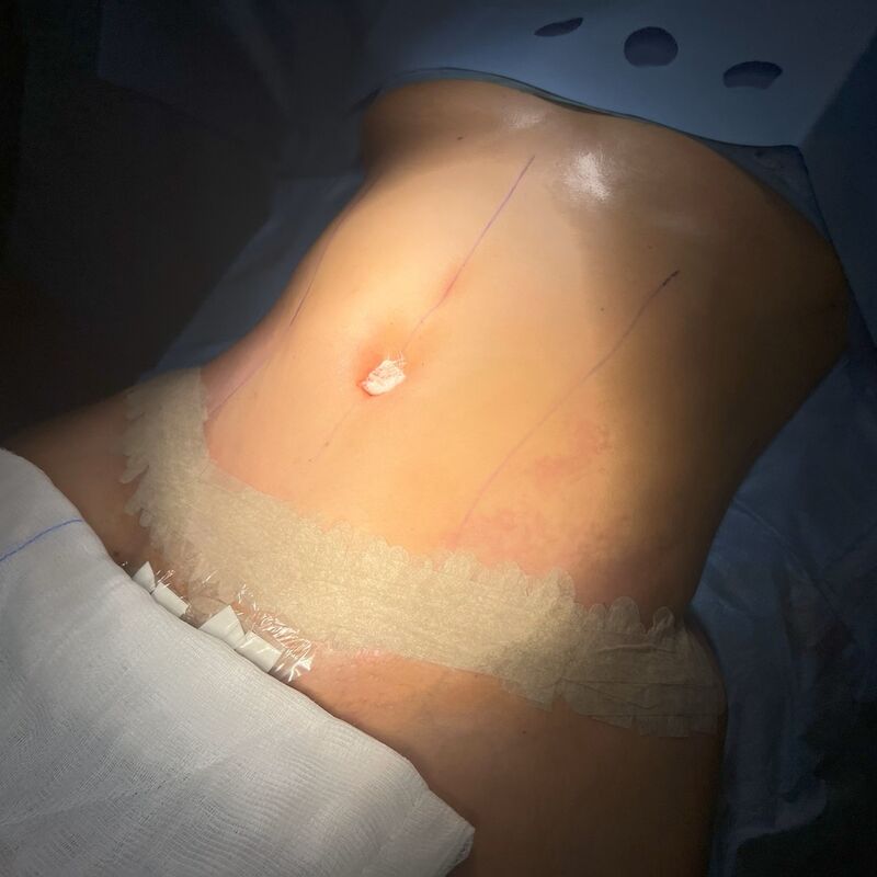 Avram voor Buikwandcorrectie plus Lipo