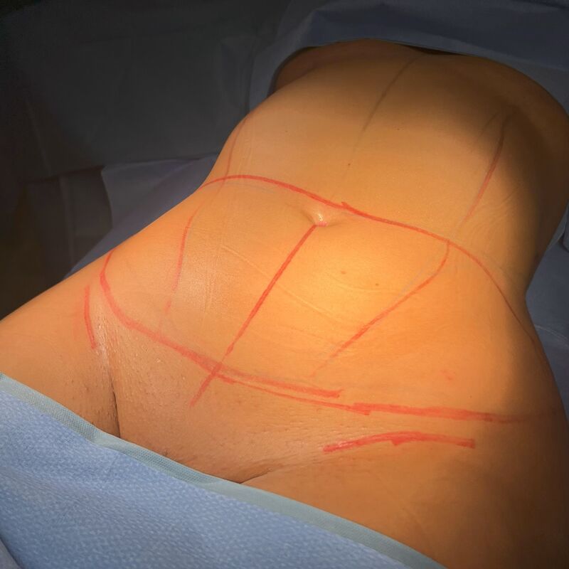 Avram voor Buikwandcorrectie plus Lipo