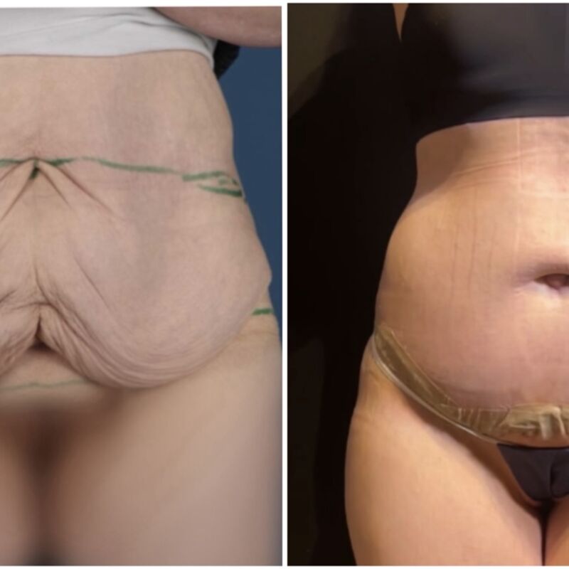 Melonie, na 70 kilo afgevallen nu eindelijk dat huid weg laten halen