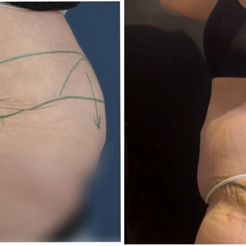 Melonie, na 70 kilo afgevallen nu eindelijk dat huid weg laten halen