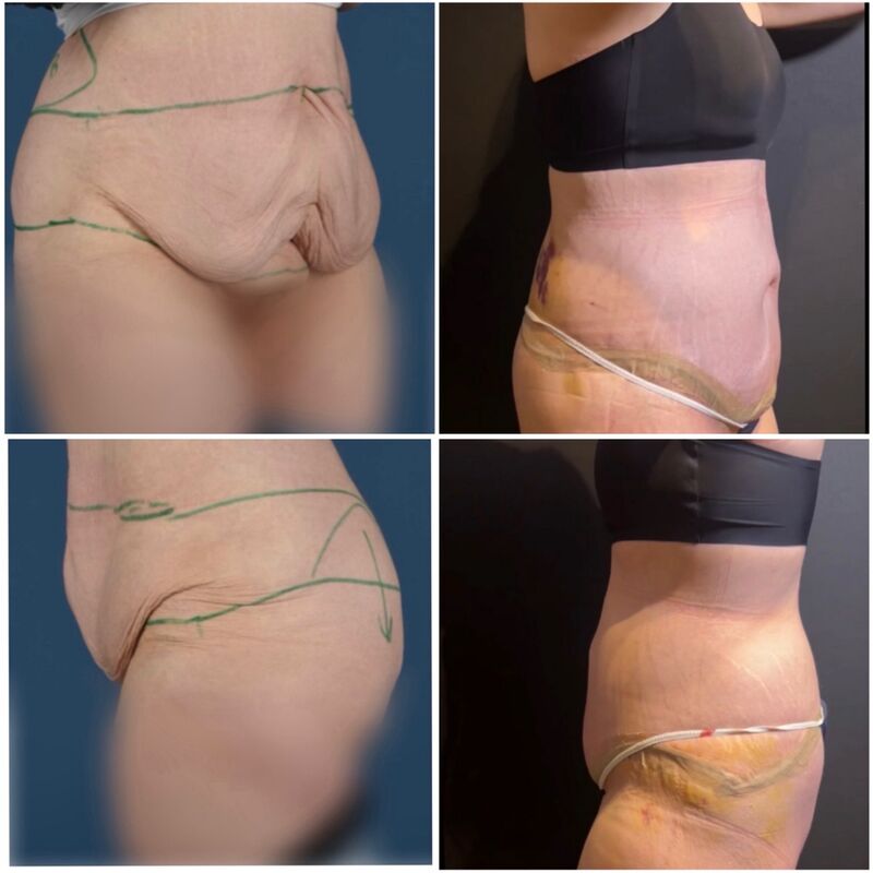 Melonie, na 70 kilo afgevallen nu eindelijk dat huid weg laten halen