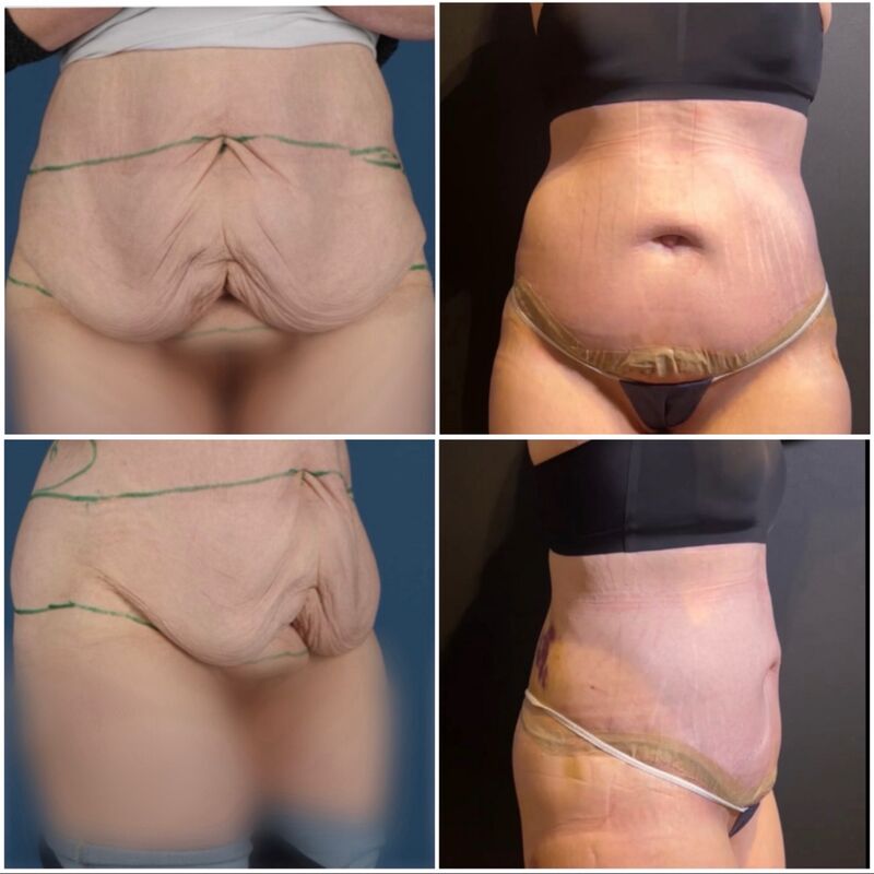 Melonie, na 70 kilo afgevallen nu eindelijk dat huid weg laten halen