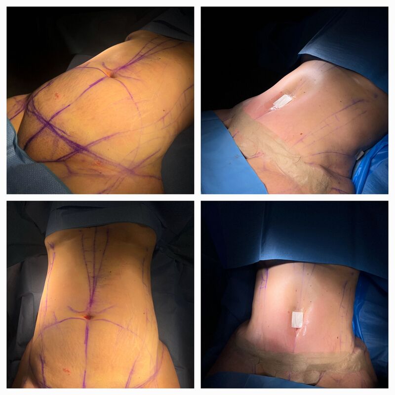 Caroline, kostenplaatje voor buikwandcorrectie in NL te hoog