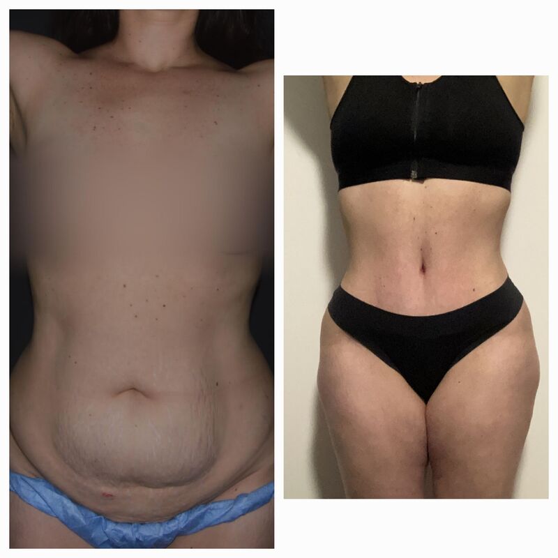 Caroline, kostenplaatje voor buikwandcorrectie in NL te hoog