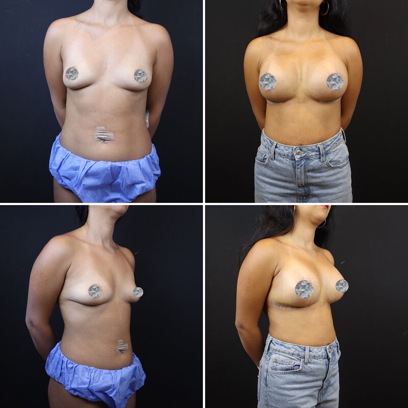 Neus en borstcorrectie voor Nicole