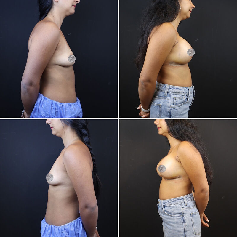 Neus en borstcorrectie voor Nicole