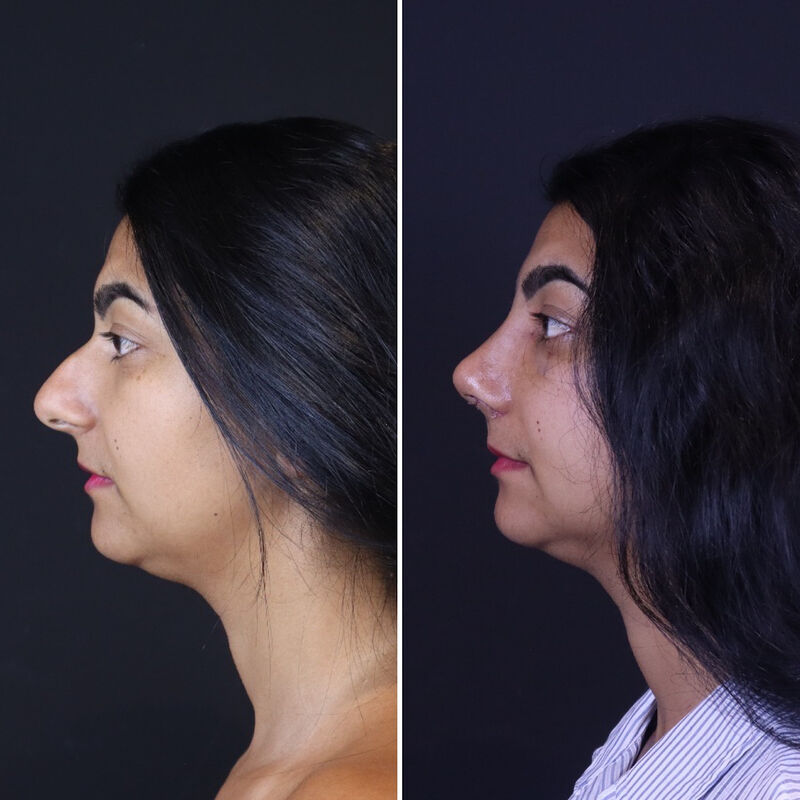 Neus en borstcorrectie voor Nicole