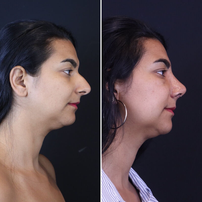 Neus en borstcorrectie voor Nicole