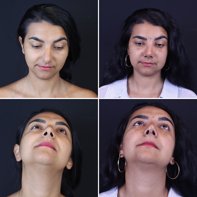 Neus en borstcorrectie voor Nicole