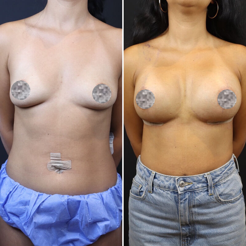 Neus en borstcorrectie voor Nicole