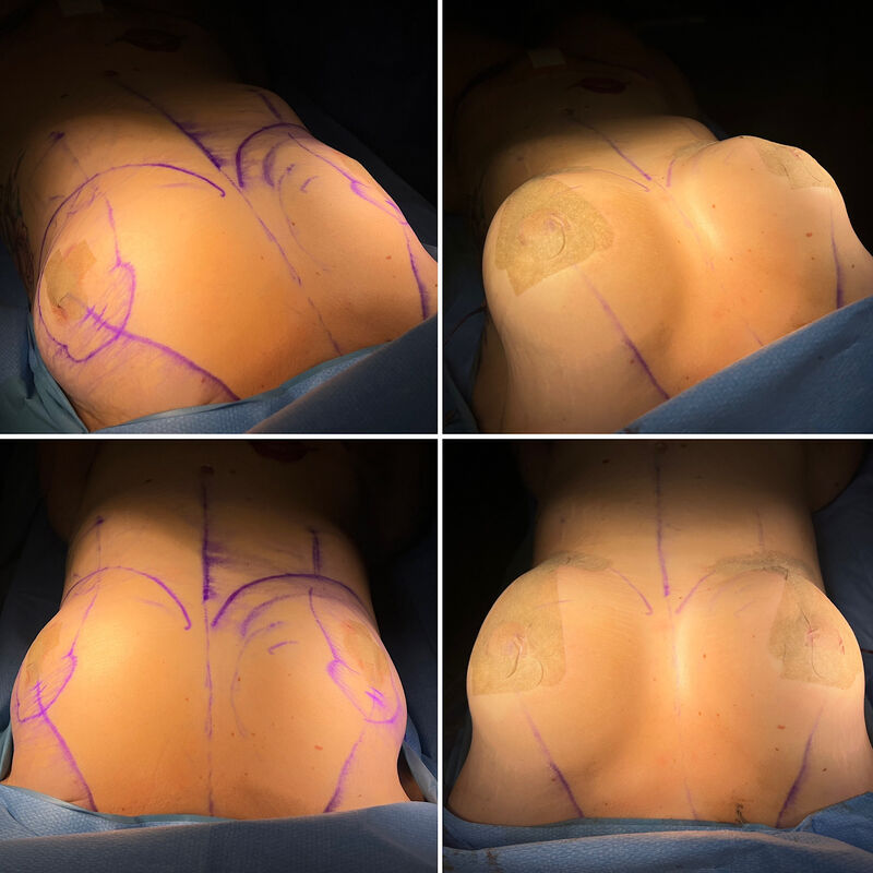 Neus en borstcorrectie voor Nicole