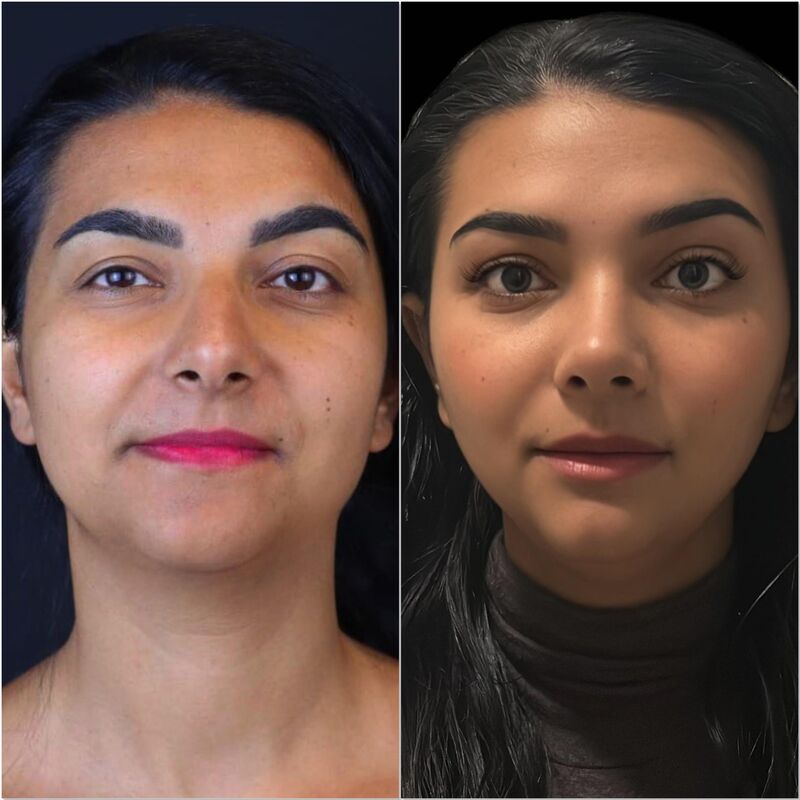 Neus en borstcorrectie voor Nicole