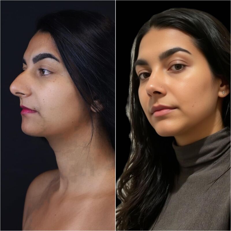 Neus en borstcorrectie voor Nicole