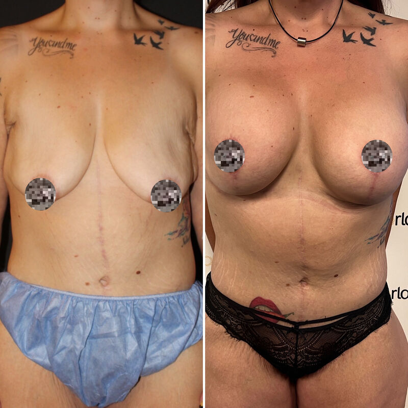 Colinda, totale make over (buikwand, lower body, borst en beenlift)