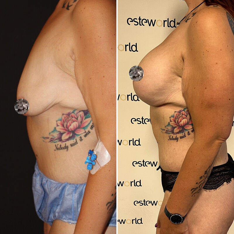 Colinda, totale make over (buikwand, lower body, borst en beenlift)