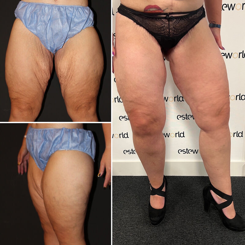 Colinda, totale make over (buikwand, lower body, borst en beenlift)